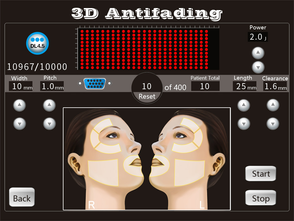 3D HIFU machine(image 2) 3D HIFU machine(image 2)