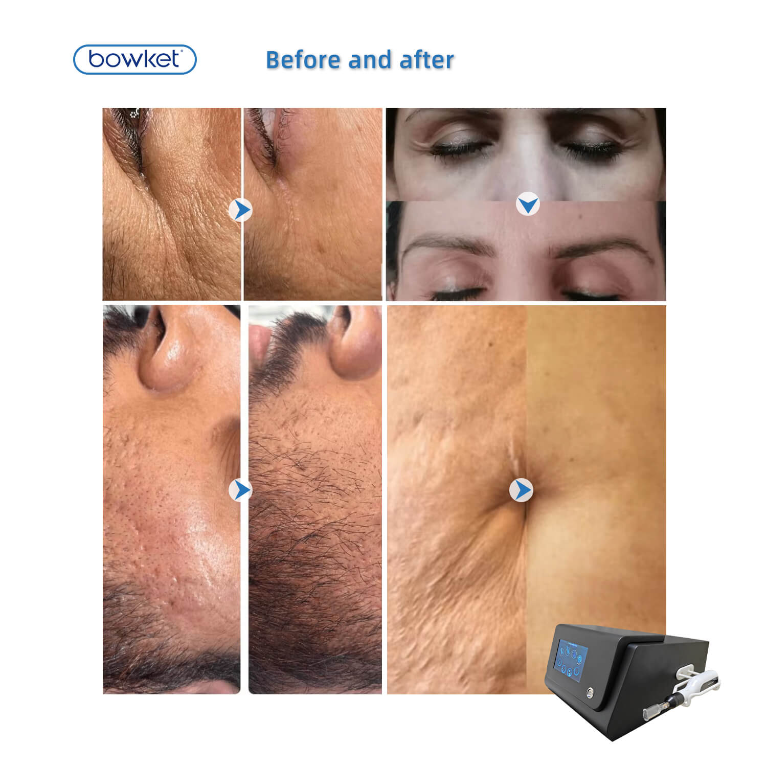 Bowket acne treatment spot remove cold plasma machine beauty device(image 10)