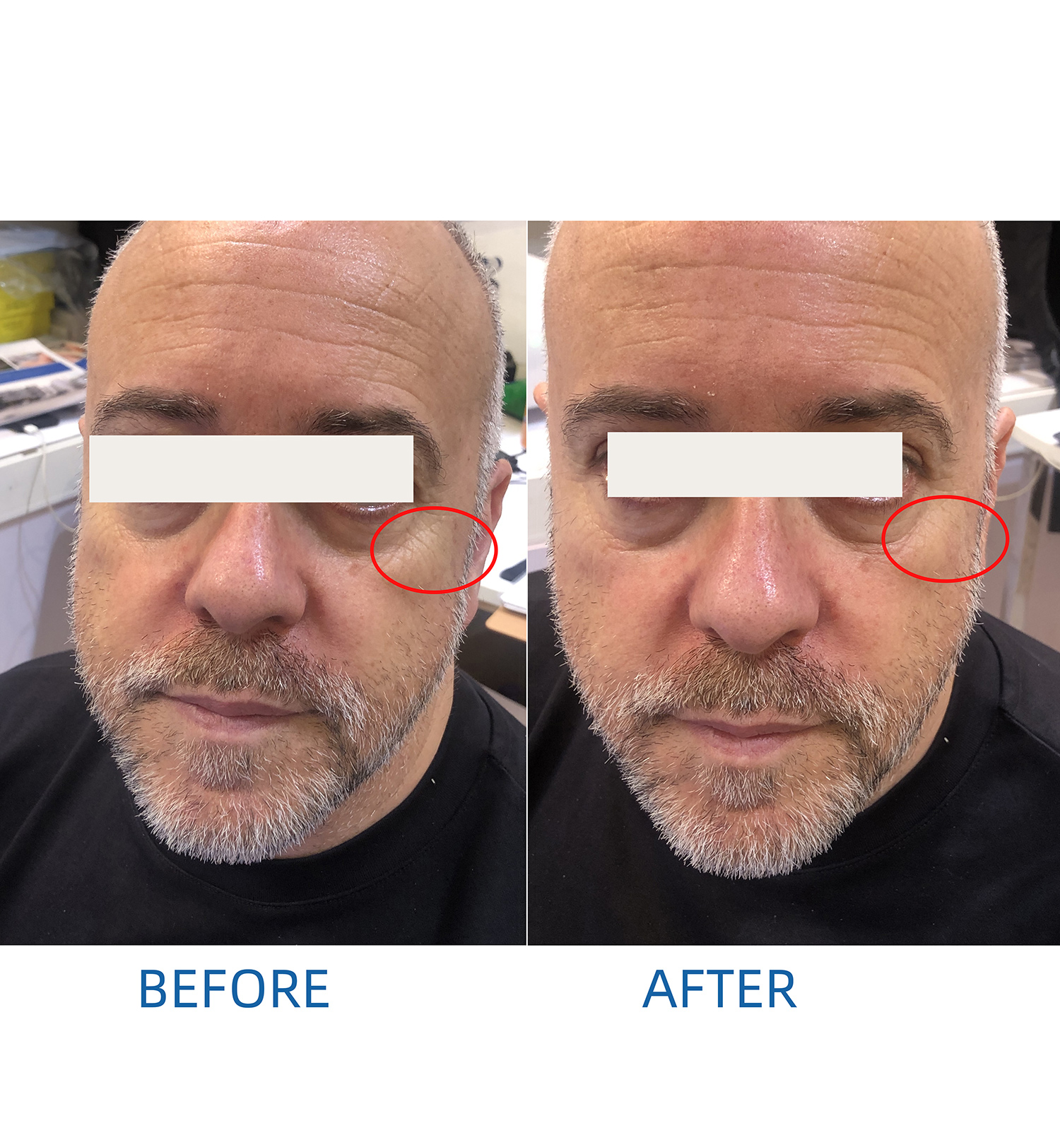 【磁脸PEFACE】Bowket  skin tightening facial ems face lifting machine(image 12)